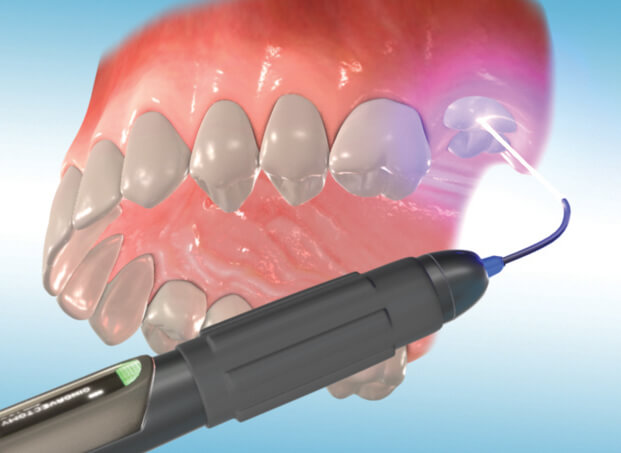 Laser Exposure Of Impacted Teeth